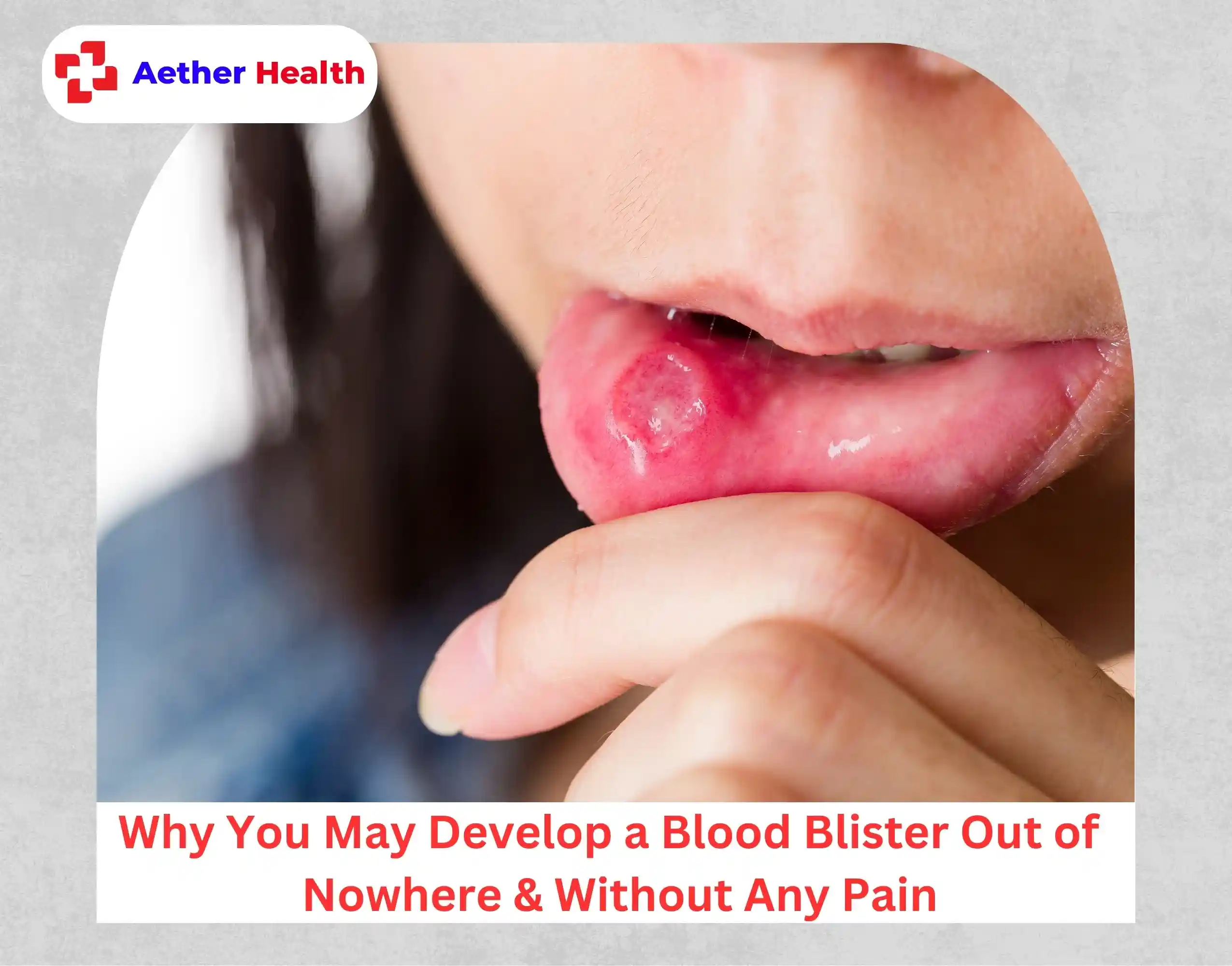Why You May Develop a Blood Blister Out of Nowhere & Without Any Pain